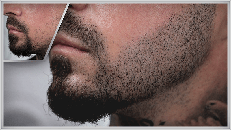 beard scalp micropigmentation result