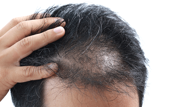 A man with diffuse hair loss – his scalp is very visible