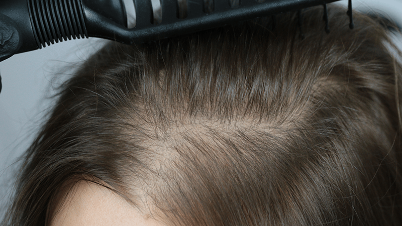 A woman with diffuse hair loss and visible scalp