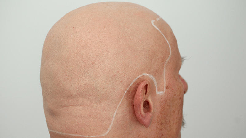 A man with alopecia totalis gets his new hairline drawn on