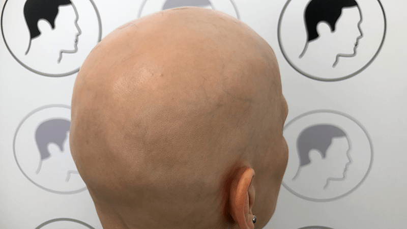 A woman with a completely bald head caused by alopecia totalis
