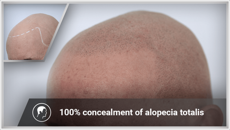 A man with alopecia totalis regains normal hair density