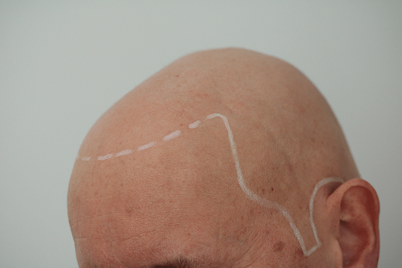 A man with alopecia universalis gets his new hairline