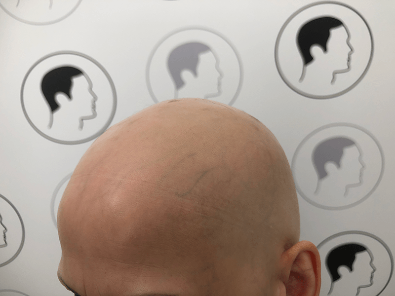 Woman with a completely bald head