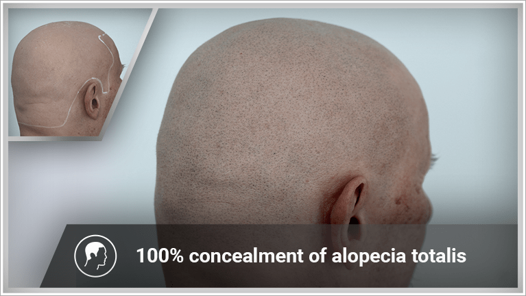 alopecia universalis causes alopecia universalis causes