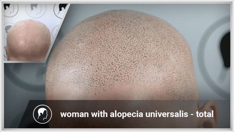 A woman with alopecia universalis can still feel good without her wig on, thanks to scalp micropigmentation.