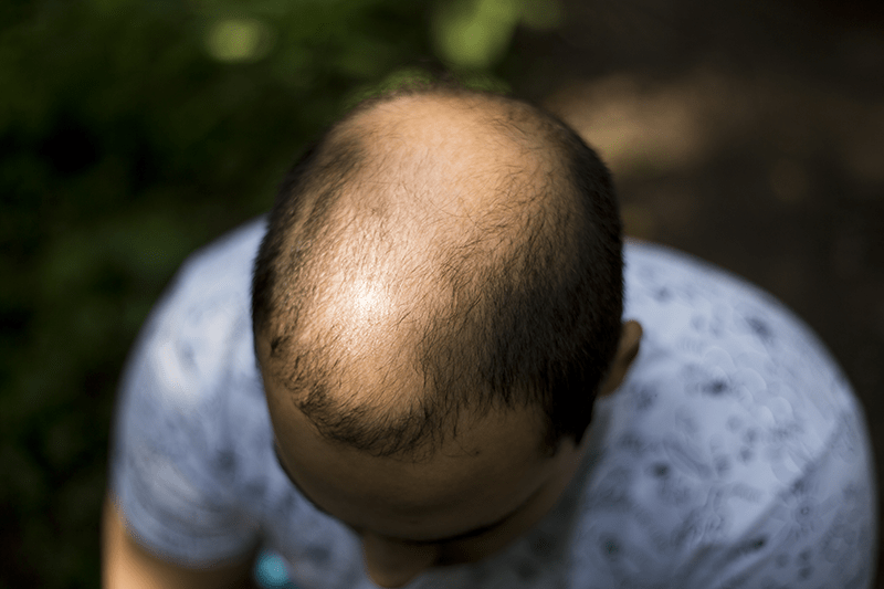 A man with severe hair loss shortly before going completely bald