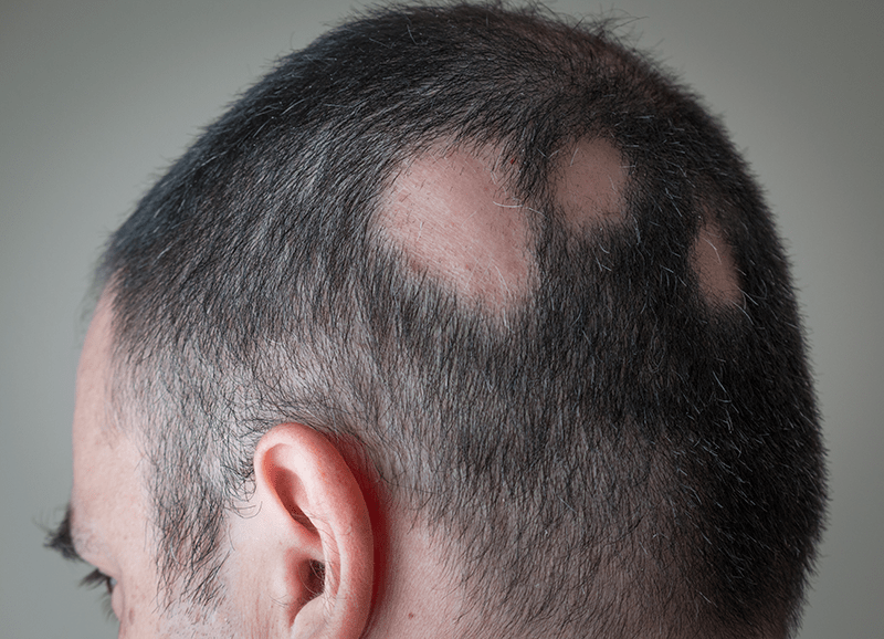 A man with alopecia areata has bald patches at the back of his head