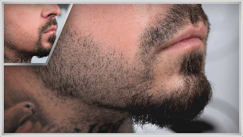 Beard micropigmentation result