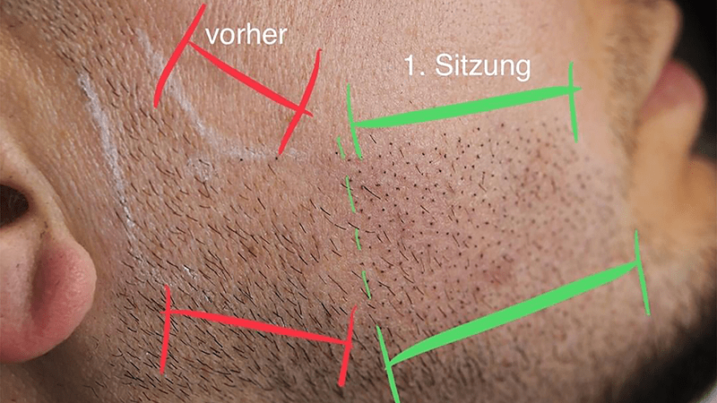 A fuller look is created using beard micropigmentation.