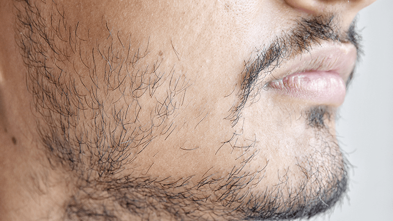 Refreshing scalp micropigmentation at the back of the head