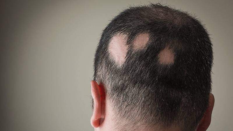A man with circular hair loss at the back of his head