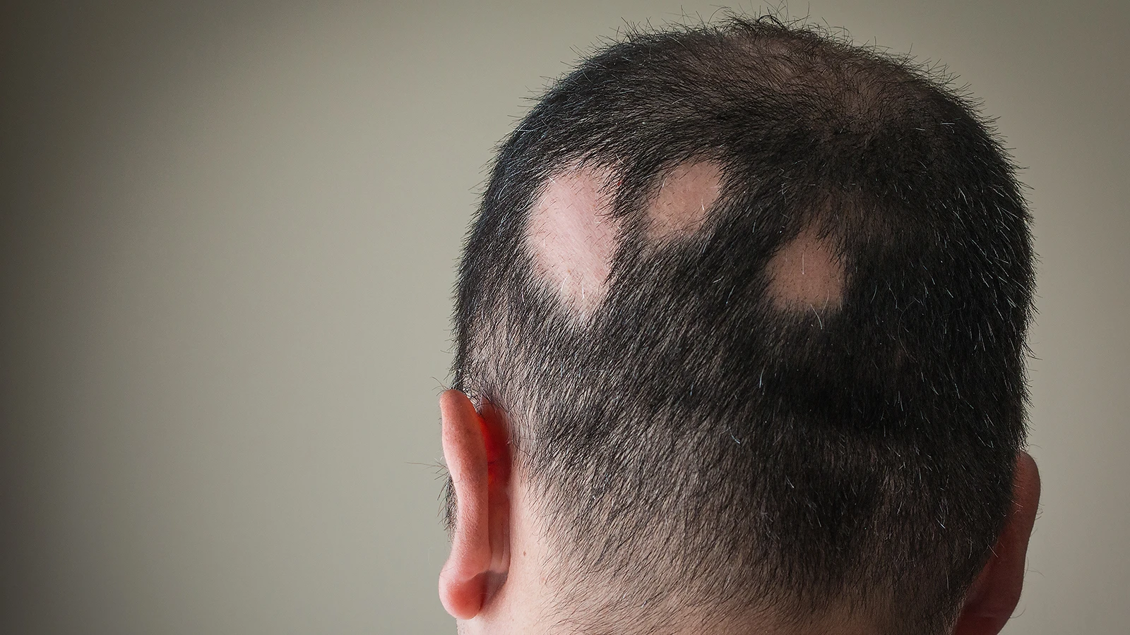 Alopecia areata - Autoimmune circular hair loss