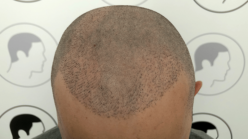 An FUE hair transplant done badly