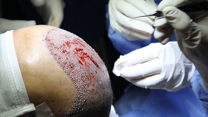FUE hair transplant in progress