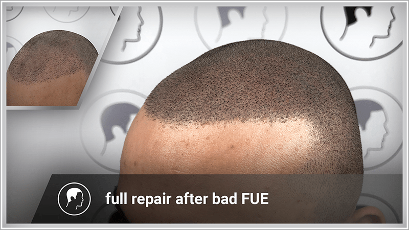 At last, full hair density thanks to scalp micropigmentation after FUE