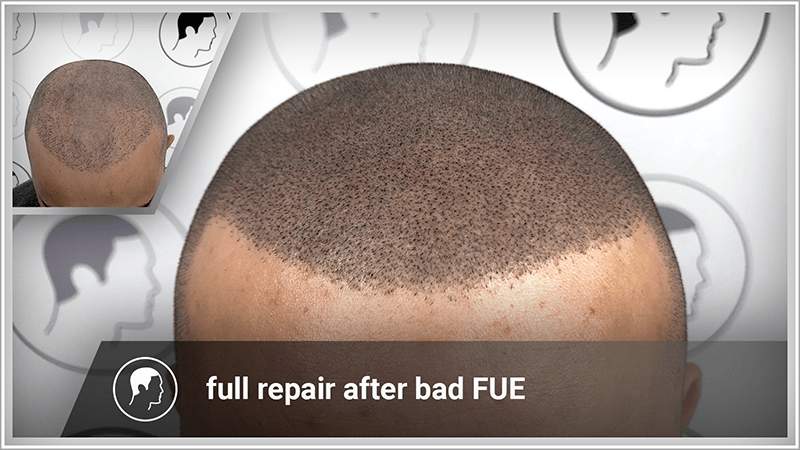 Scalp micropigmentation conceals an FUE hair transplant