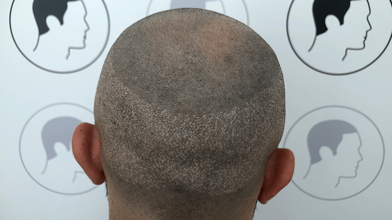A client with FUE scars on the back of his head