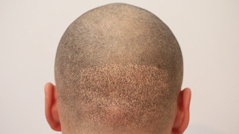 https://scalp-pigmentation.com/img/pages/fue-hair-transplant/slides-scars/scars-on-the-back-of-her-head-after-fue-sm-1x.webp