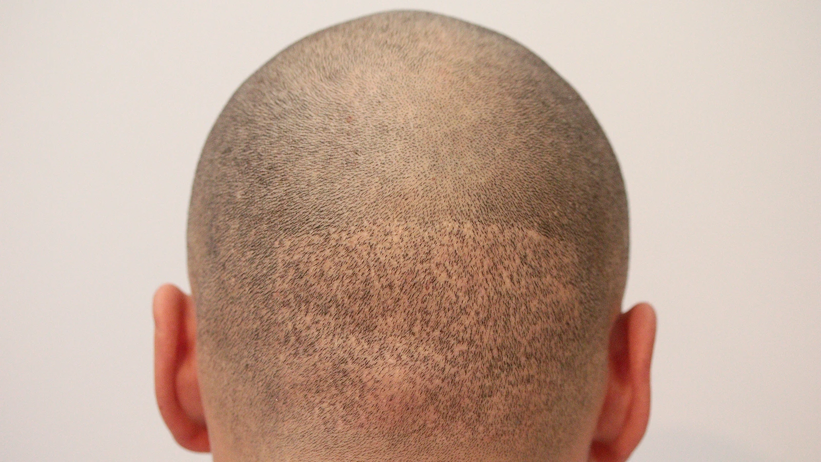 FUE Hair transplant - what to expect and alternatives