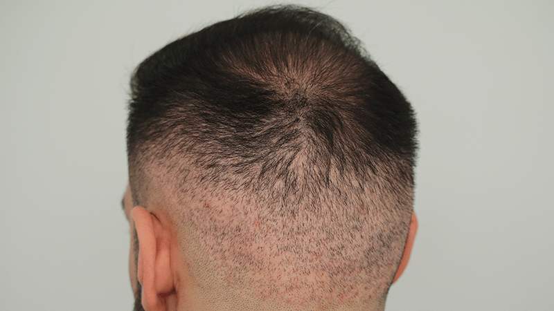 Reddened donor area after FUE