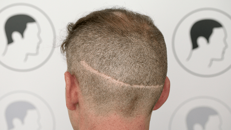 Unsightly strip scar on the back of the head