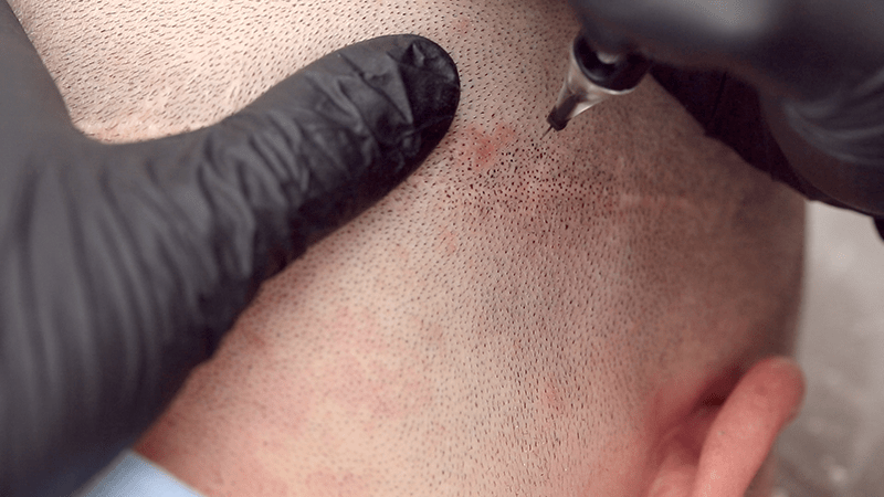 FUT scar micropigmentation procedure