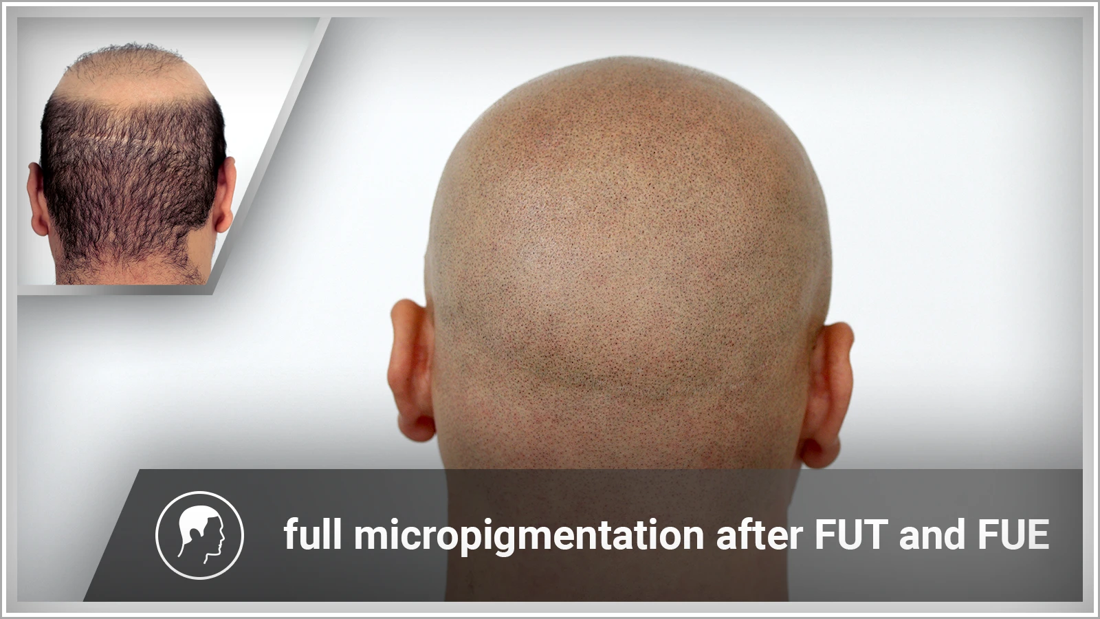 FUT hair transplant - risks and benefits