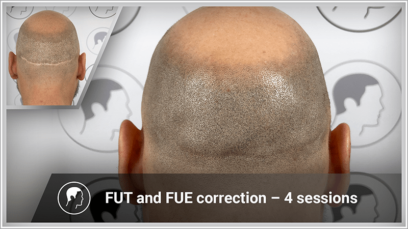 Concealing FUT and FUE scars
