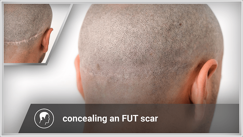An unsightly strip scar becomes invisible thanks to scar micropigmentation