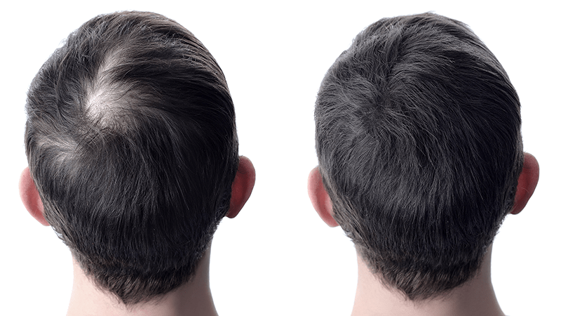 Before-and-after comparison of hair thickened with hair fibres