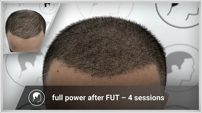 After an FUT hair transplant, scalp micropigmentation creates the illusion of maximum density.