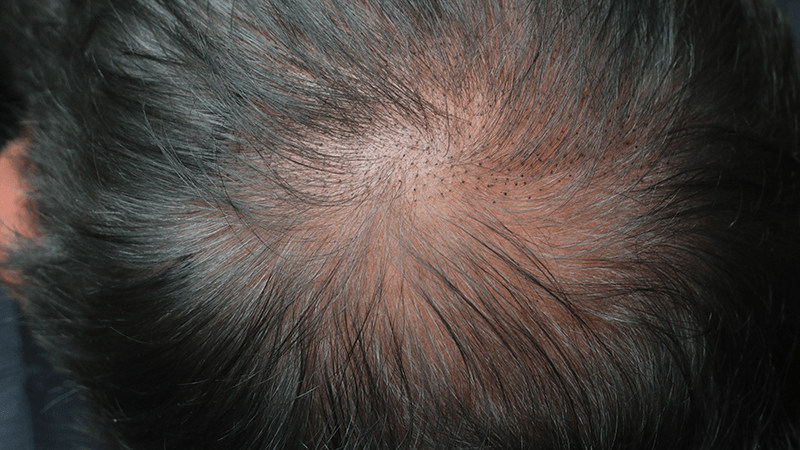 Scalp micropigmentation in progress, thickening the hair on the tonsure.