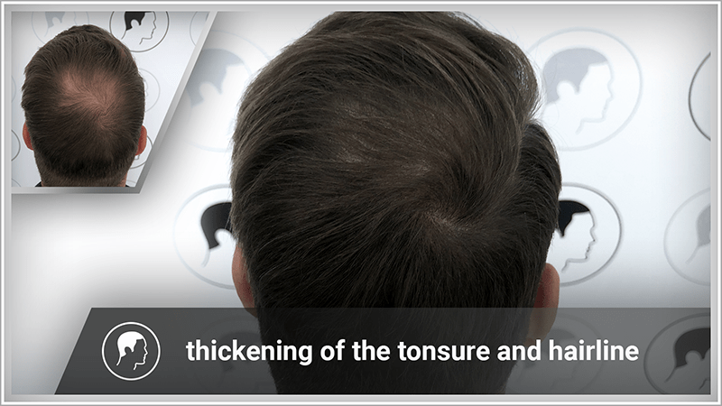 Scalp micropigmentation is used to thicken a thinning tonsure.
