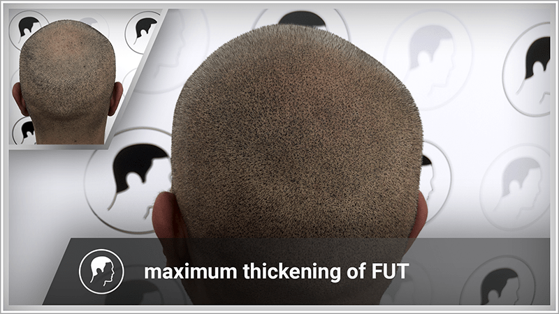 Thickening a thinning tonsure with scalp micropigmentation.