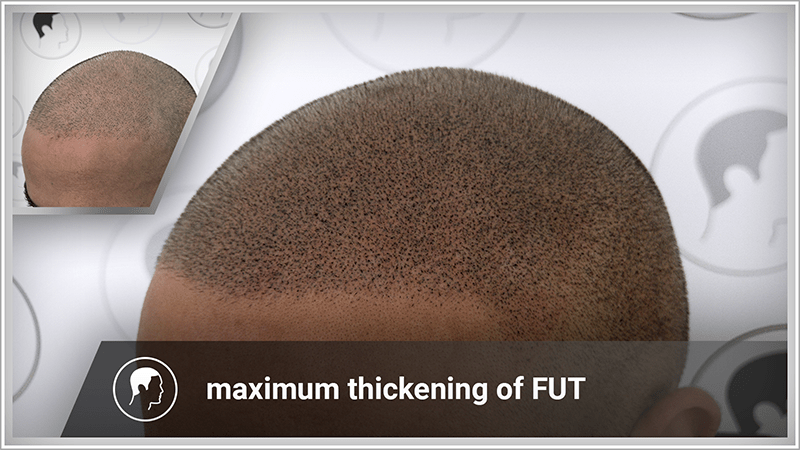 Hair thickening after an FUT hair transplantation.