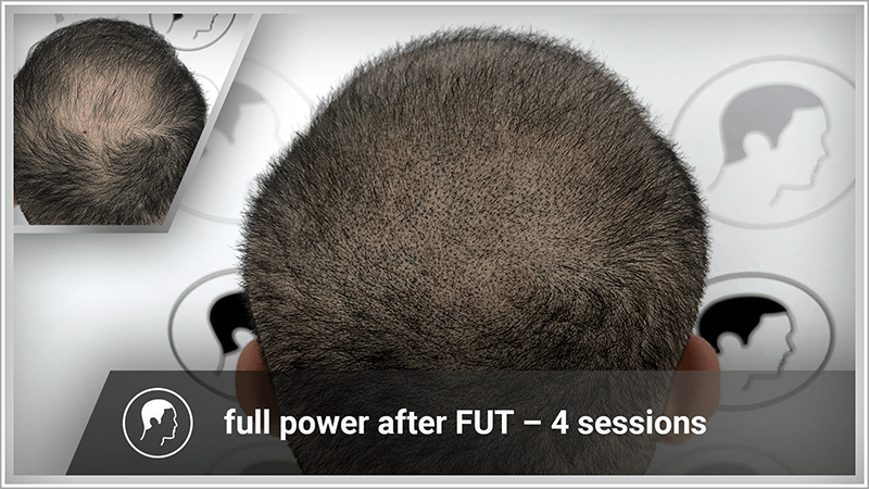 Scalp micropigmentation improves an FUT hair transplant on the tonsure.