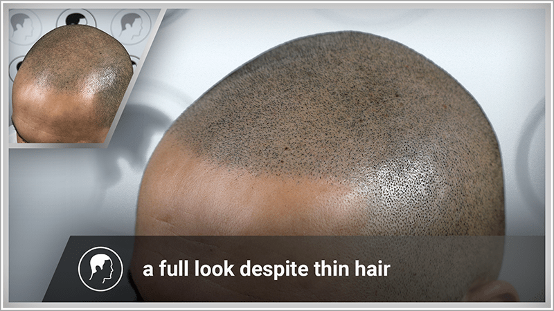 Scalp micropigmentation  is a sustainable solution for hair loss.