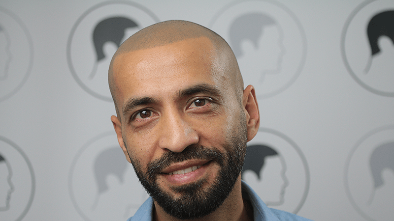 Ahmad smiles after his scalp micropigmentation