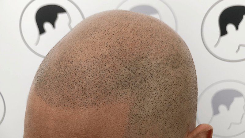 Client’s micropigmentation is slightly faded after many years