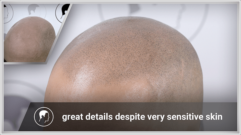 Scalp micropigmentation with excellent details despite sensitive skin.
