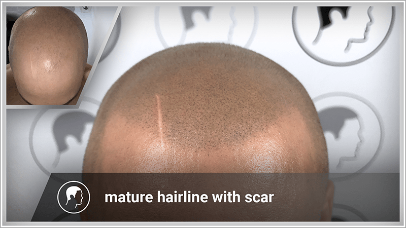 Scalp micropigmentation with mature hairline and scar.