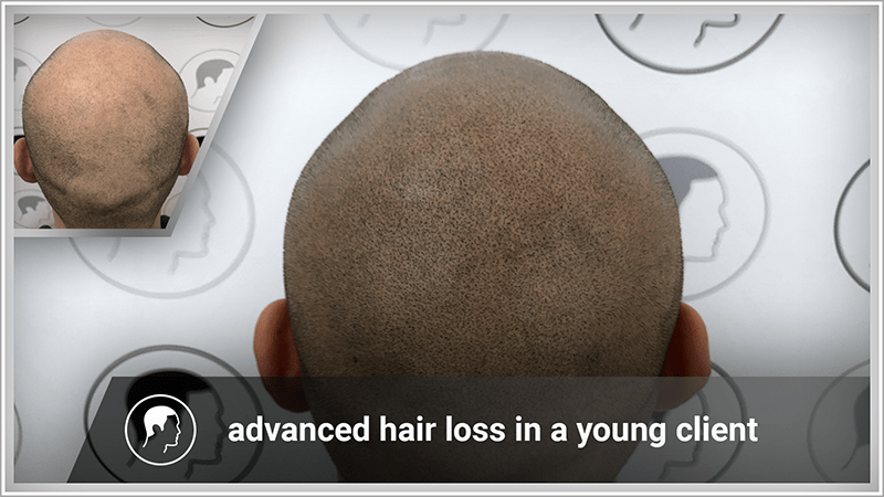 Scalp micropigmentation conceals maximum hair loss in a young client.