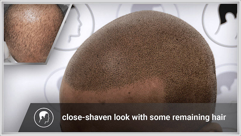 Scalp micropigmentation as a close-shaven look with some remaining hair