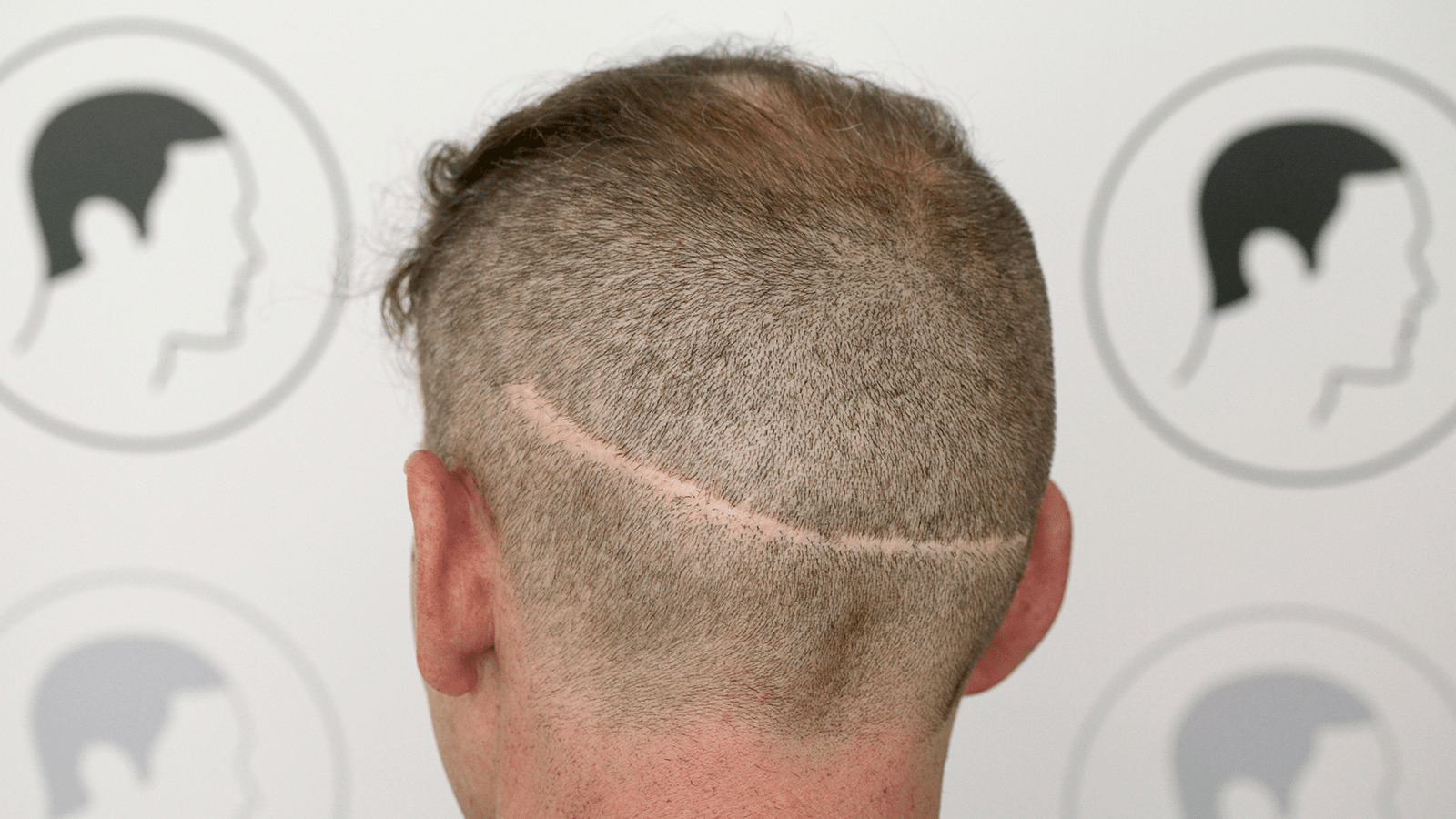 Scar camouflage with Scalp micropigmentation