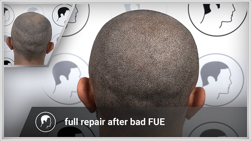 FUE scars in the donor area are fully concealed.