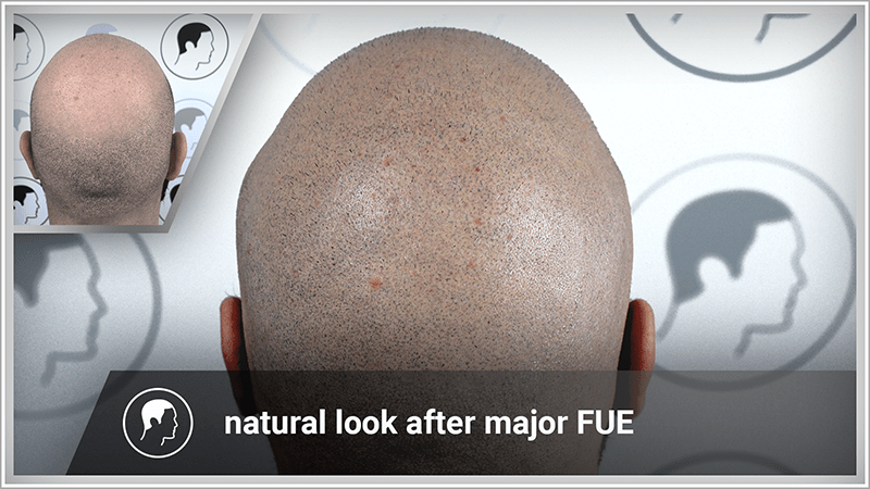 Donor area and top of head restored to full hair density after scalp micropigmentation.