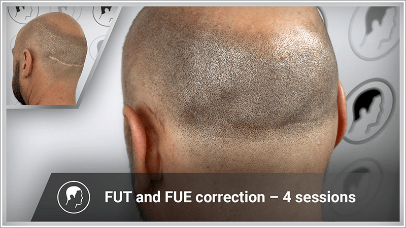 FUE and FUT scar micropigmentation result.