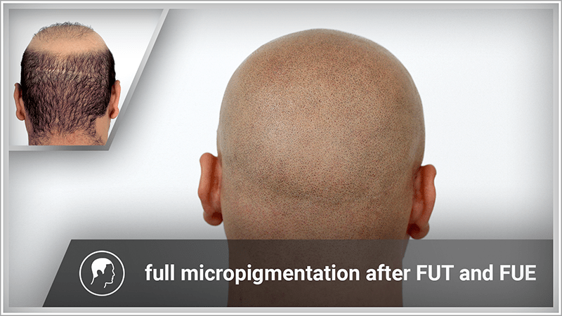 Scalp micropigmentation conceals FUE and FUT scars.