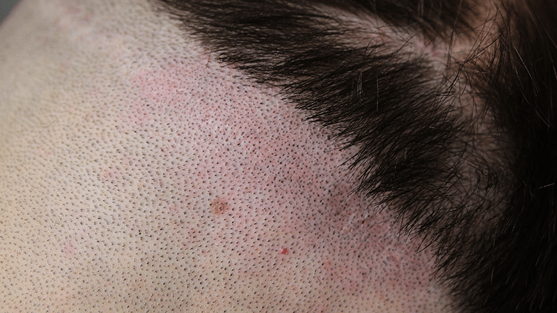 Concealing the strip scar with micropigmentation